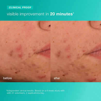 Acne Biotic Moisturizer